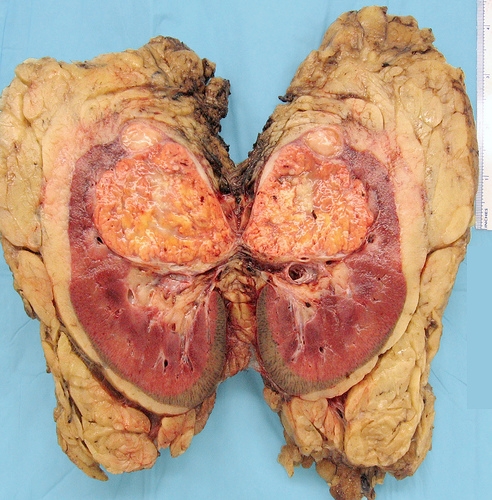 Cancerul renal